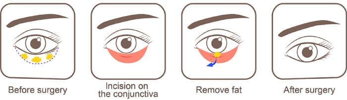 HR Plastic Surgery - How to Treat Lower Eyelid Bags